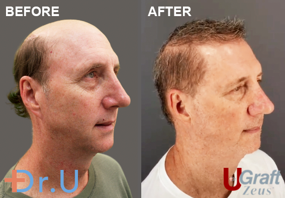 Hair Transplant Before and After | ClinicExpert