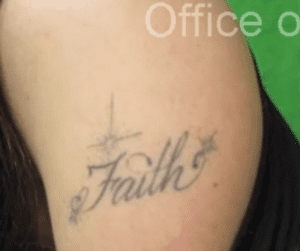 Manhattan Beach Patient Thrilled With Results After Laser Tattoo Removal