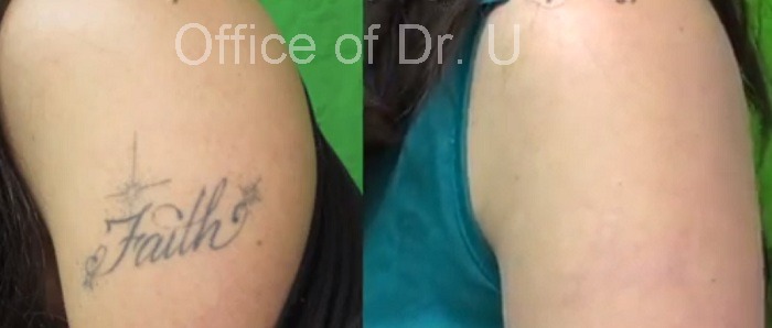 VIDEO: Laser Tattoo Removal Los Angeles Patient Video Results - Dr. U Hair  & Skin Clinic | FUE Hair Restoration, Dermatology and Laser Surgery | Los  Angeles, Manhattan Beach | Dr Sanusi Umar MD