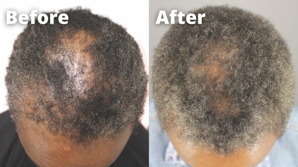 Another patient before and after picture results featured on the published peer-review journal demonstrating the positive response of GASHEE on CCCA patients.