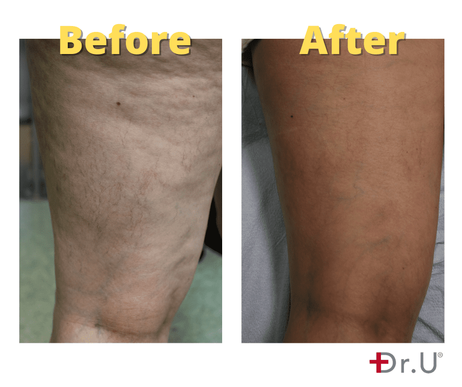 Vein Removal Los Angeles  Best Treatment for Varicose Veins