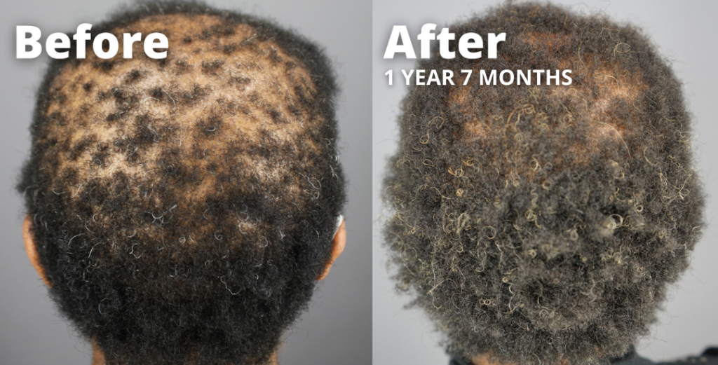 CCCA Patient Treated Using GASHEE - Natural Hair Growth Results V2*