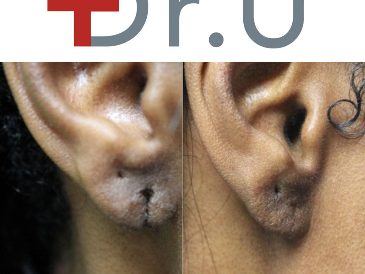 5 Facts About Earlobe Surgery - Restore SD Plastic Surgery