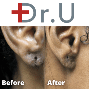 Split Earlobe Repair Results For Los Angeles Patient*