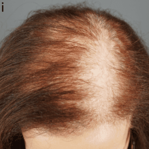 Example of LPP patient showing symptoms of LPP such as scalp redness and scarring hair loss.*