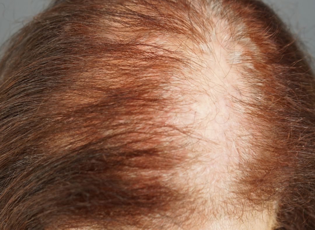 VIDEO: What is Lichen Planopilaris AKA LPP? - Dr. U Hair & Skin Clinic |  FUE Hair Restoration, Dermatology and Laser Surgery | Los Angeles,  Manhattan Beach | Dr Sanusi Umar MD
