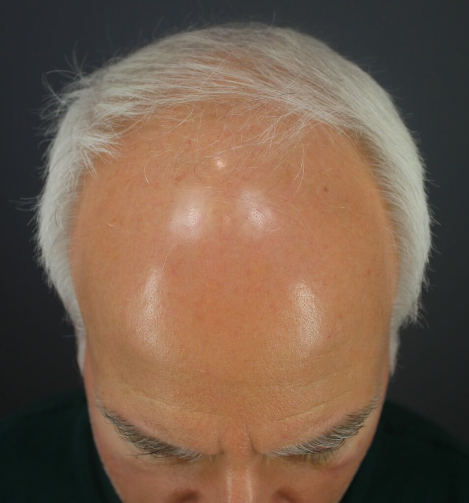 Male Pattern Baldness