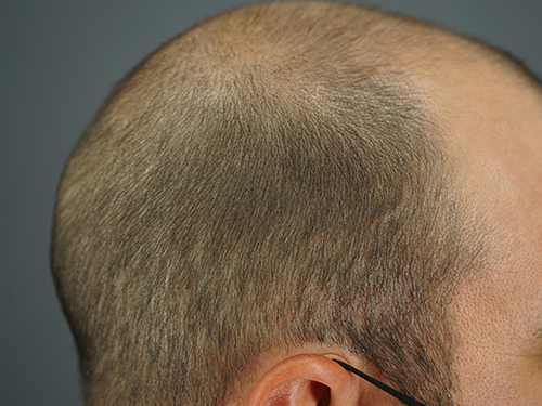 A New System to Evaluate FUE Hair Transplant Patients