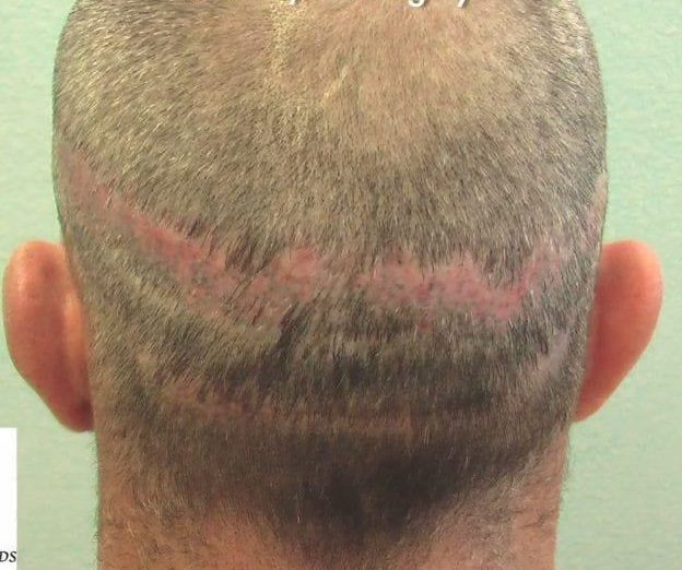 FUE Vs. FUT Hair Transplant: The Pros And Cons - Dr. U Hair & Skin ...