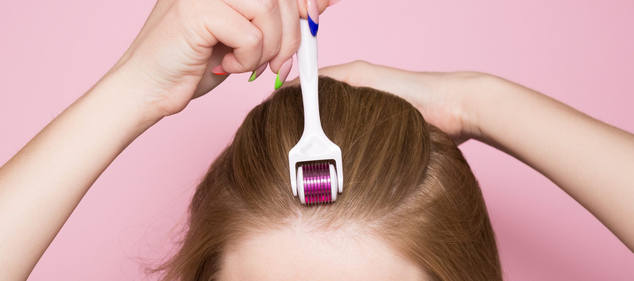 Microneedling as a hair loss treatment