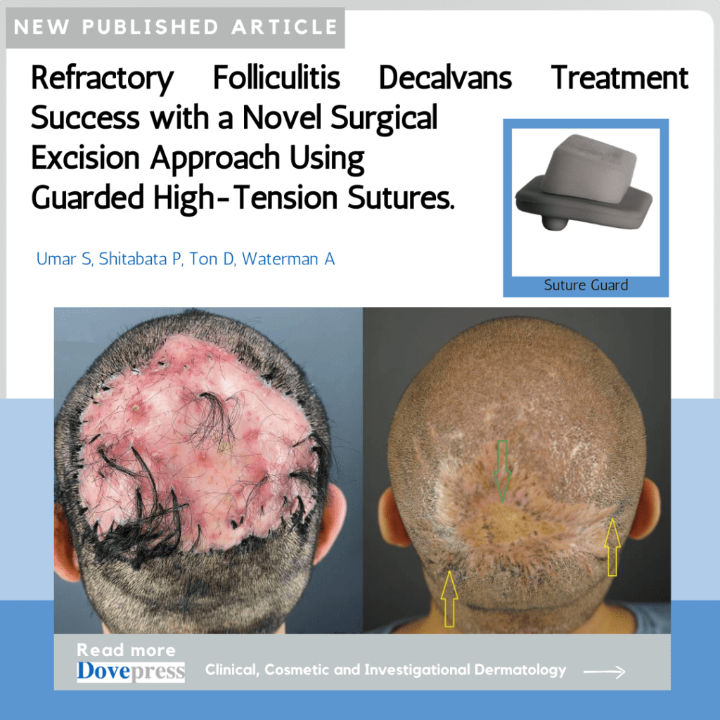 folliculitis scalp cure