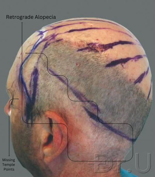 Some of the characteristics of retrograde alopecia are hair loss at the nape and temples.