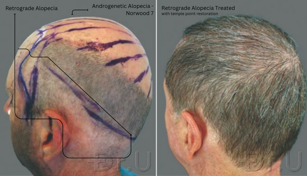 NW 7 Patient with retrograde alopecia and temple loss before and after FUE hair restoration using head, beard, and body hair transplants