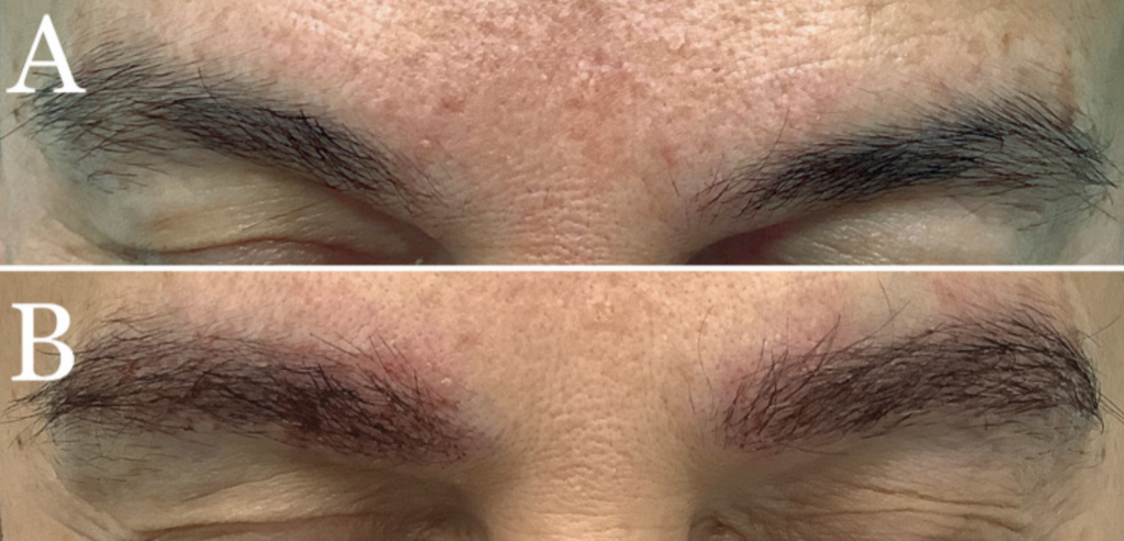 Long-Hair FUE allows an immediate  “preview” of the results. This woman already has thicker and more defined eyebrows shortly after her procedure.