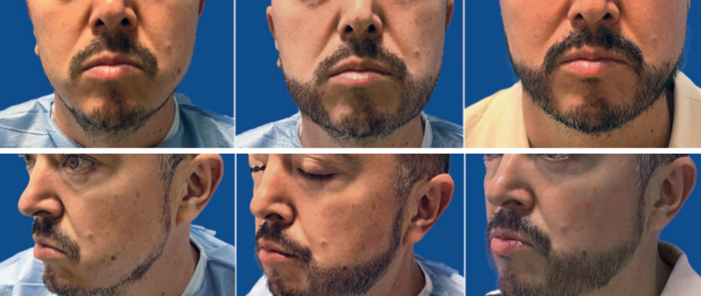 Front and oblique views of a Hispanic patient before his beard restoration surgery with long shafts (left), immediately after (center), and 10 days post-surgery (right).