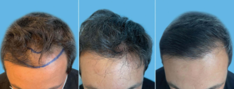Left to right: Patient before long-hair FUE; Patient forty-eight hours post-surgery. Copyright ©2021. Dove Medical Press; Patient three years after surgery.