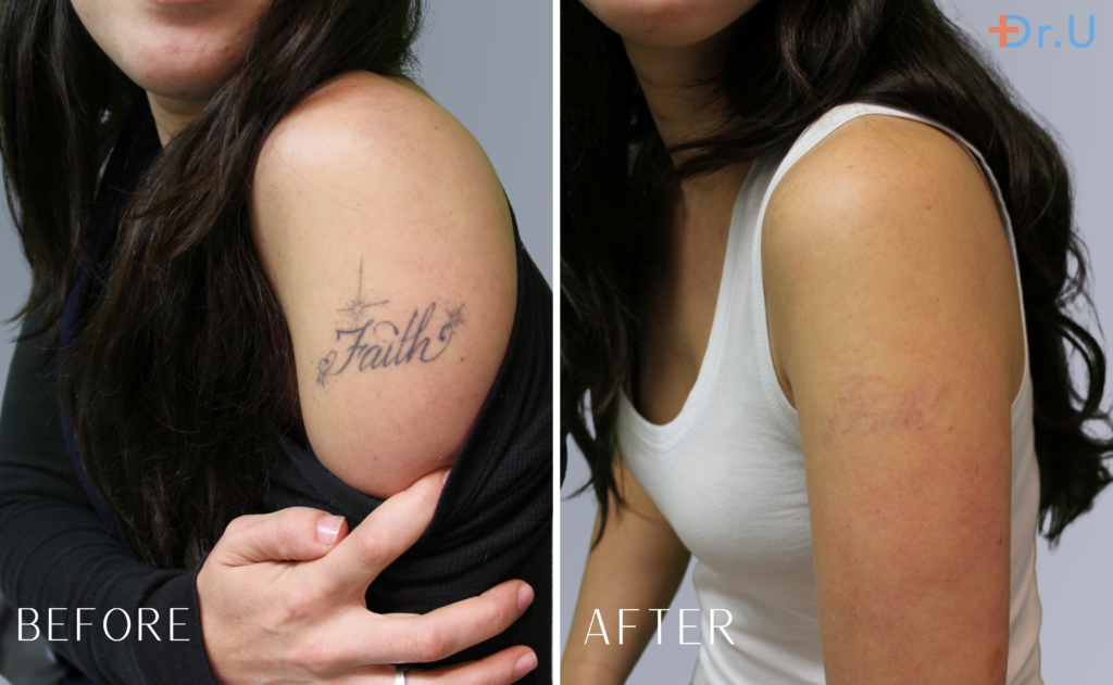 This young woman wanted to remove her arm tattoo. It took only three laser treatments at Dr. U Hair and Skin Clinic to remove her tattoo completely.