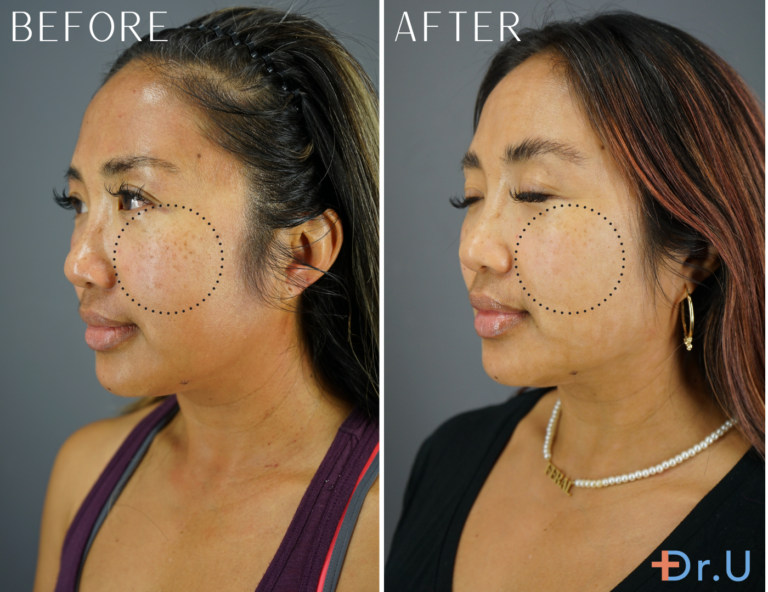 The patient wanted to reduce the appearance of her sun spots and opted for the Lutronic Ultra Glo laser treatment. *