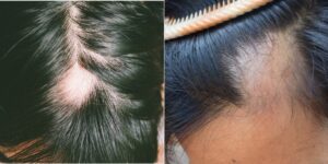 Alopecia Areata has noticeable hair loss patches in different parts of the scalp, as seen in the above images. 