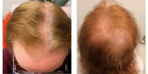 A patient suffering from Androgenetic Alopecia (AGA). The images represent her condition before intervention and treatment by Dr. Umar. 