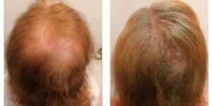 A patient diagnosed with Androgenetic Alopecia (AGA). Frame A is before treatment, and frame B is after treatment under the care of Dr. U. 