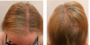 A 68-year-old Caucasian woman patient receiving care under Dr. Sanusi Umar. The images above show the front and back parts of the head after treatment with products by Dr.Ugro Gashee FineTouch Laboratories.