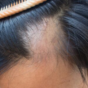 A patient with Alopecia Areata (AA)