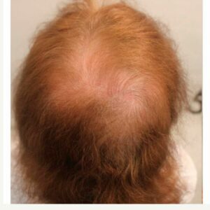 A patient with Androgenetic Alopecia (AGA)