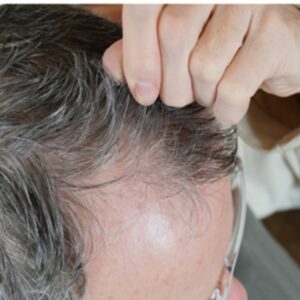 Visible patchy hair loss resulting from constant pulling. 