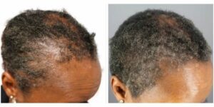 CCCA patient example:  Notice the centrifugal spreading of scarring hair loss. Frame A is before treatment, and frame B is after treatment under the care of Dr. U. 