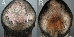 FD – Folliculitis Decalvans Surgical Removal Before and After Patient Results, 1-Year Post Surgery – Dr. U AKA The Bumpinator, Dr. U Skin & Hair Clinic. 