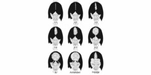 The female pattern hair loss.  A form of Androgenetic Alopecia in women. 