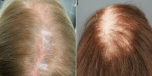 Patient Example of LPP (Lichen Planopilaris) – Notice the redness and scarring on Image 1 and the scarring hair loss on Image 2. 