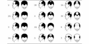 The male pattern baldness.  A form of Androgenetic Alopecia in men. 