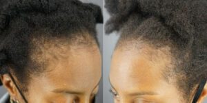 Traction Alopecia patient example:  Notice the hair loss on the scalp edges. Frame A is before treatment, and frame B is after treatment under the care of Dr. U. 