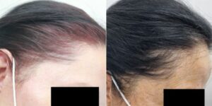 Frames A and B show patients with Frontal Fibrosing Alopecia. They used the Dr.UGro Gashee Natural Hair Products, created by Dr. Sanusi Umar. 