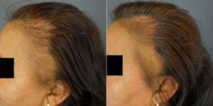 Frames A and B show a patient with Frontal Fibrosing Alopecia. After using Dr.UGro Gashee Natural Hair Products, created by Dr. Sanusi Umar, the patient (as seen in Frame A) experienced hair regrowth.