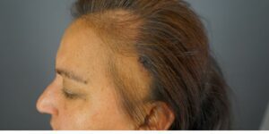 This patient with frontal fibrosing alopecia (FFA) is under the care of Dr. Sanusi Umar.