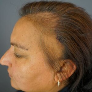 This patient with frontal fibrosing alopecia (FFA) is under the care of Dr. Sanusi Umar. 