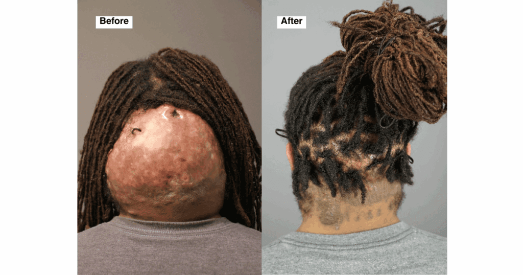 Side-by-side comparison showing Fred’s back of the scalp before surgery with a large Acne Keloidalis Nuchae (AKN) mass, and after surgery with a smooth, healed scar and natural hairline restoration