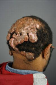 Back view of Anwar’s scalp with extensive, raised keloidal lesions caused by long-term Folliculitis Decalvans prior to surgical treatment.