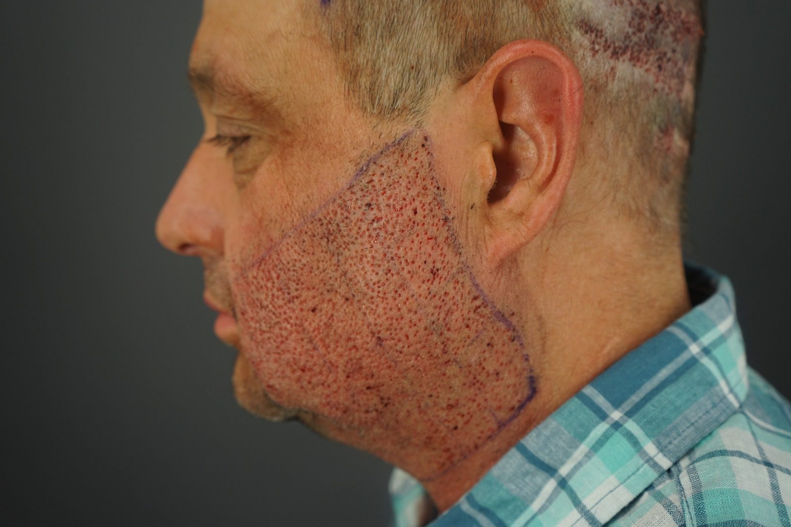 Beard donor area immediately after graft extraction using the UGraft Zeus™ system. These regions provided the high-quality grafts needed to restore Jon’s scalp.