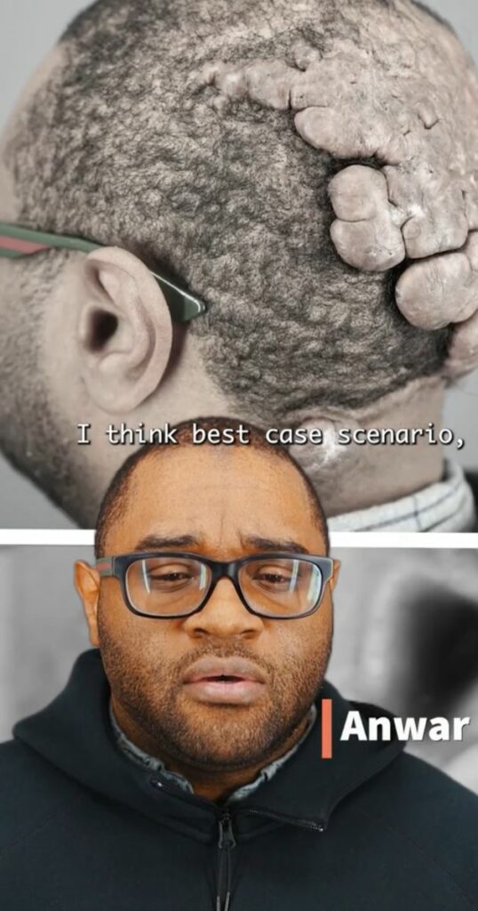 Anwar hopes to have just a hairless scar after surgery. He wants to finally be free of the FD mass which has been growing on the back of his head for the last  16 years.