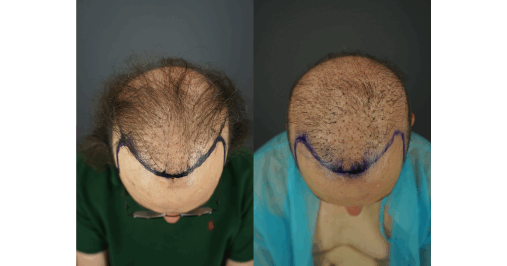Before photos comparing Jon’s shaved and unshaved states. Despite undergoing several failed hair transplants, he still shows extensive baldness. Pluggy grafts are visible and unevenly distributed, highlighting the unnatural appearance created by previous procedures.