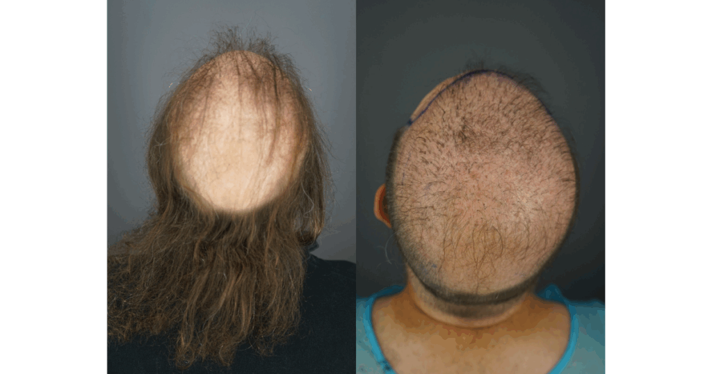 Shaving Jon’s head reveals an unnatural pattern with poorly placed grafts that failed to achieve adequate coverage.