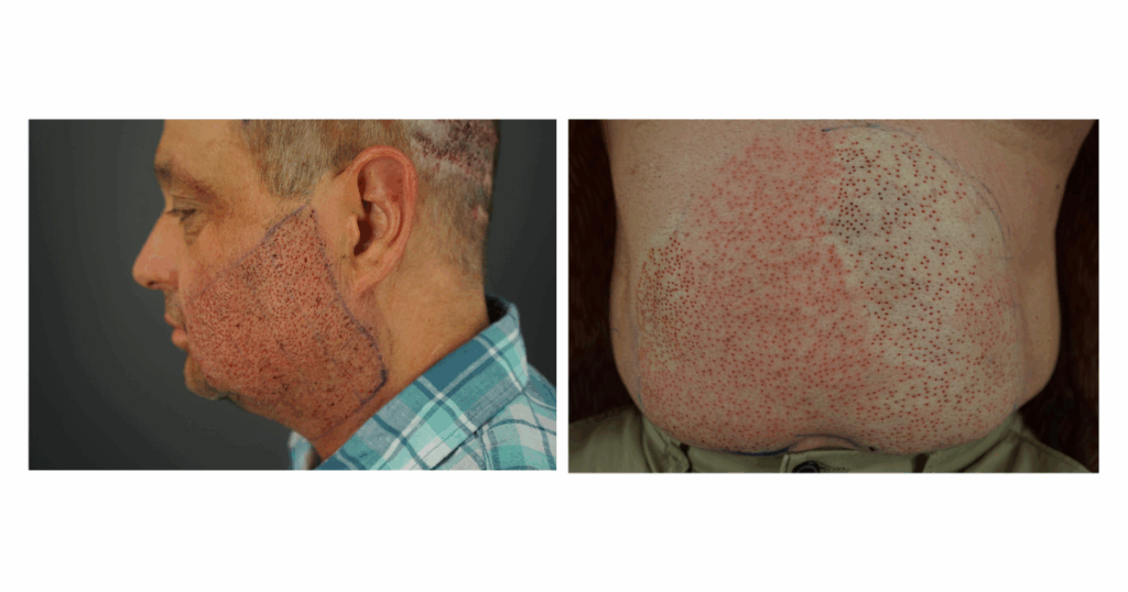 Close-up view of the abdomen and side facial profile showing tiny extraction sites after body hair graft harvesting for a hair transplant procedure.