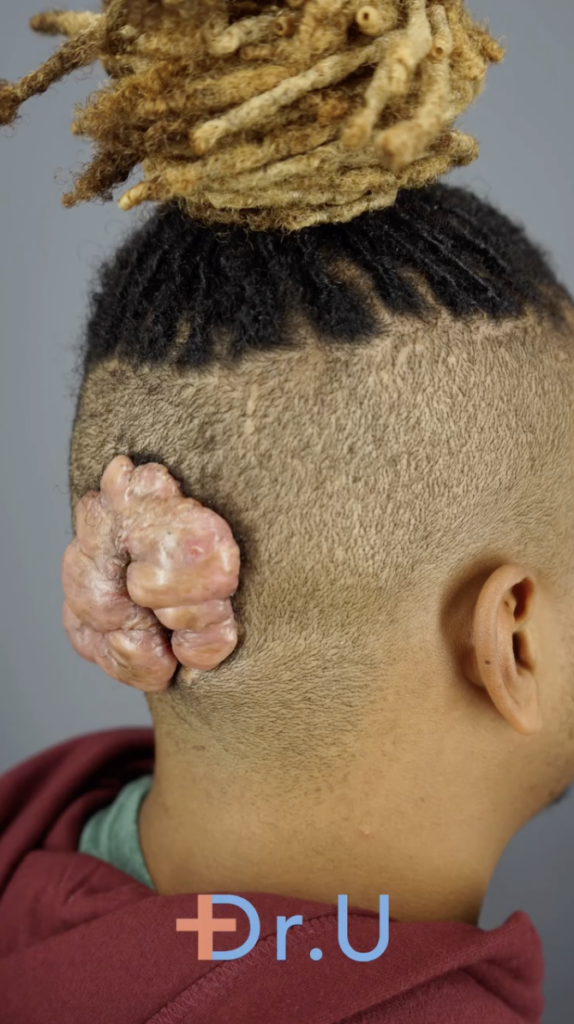 Rear-side view of a man's head with a large raised area behind the left ear.
