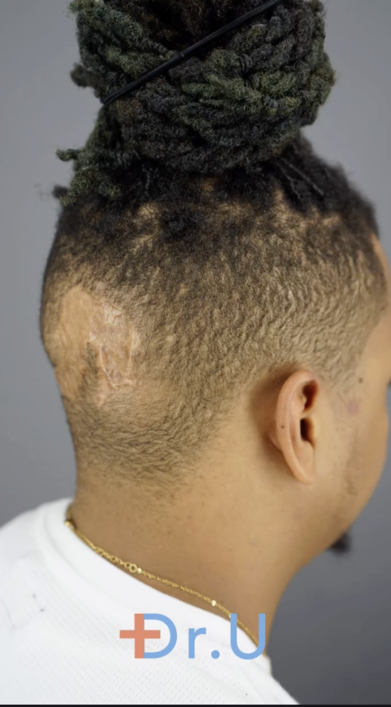 Rear-side view of a man's head with a flatter healed area behind the left ear.