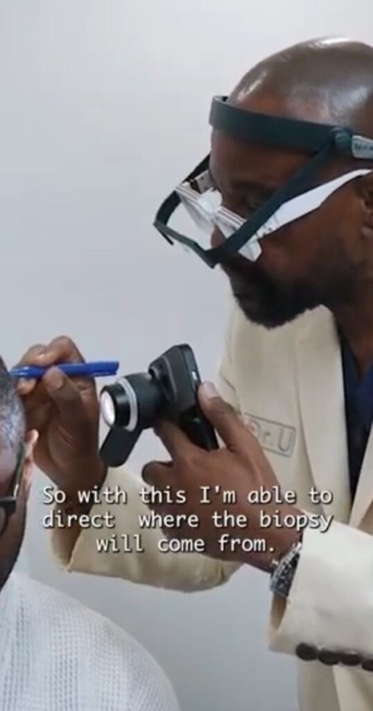 Dr. Sanusi Umar is examining Anwar’s scalp to determine the location where he will remove tissue for a biopsy. The biopsy will indicate  where the folliculitis decalvans mass ends, and where healthy tissue begins.
