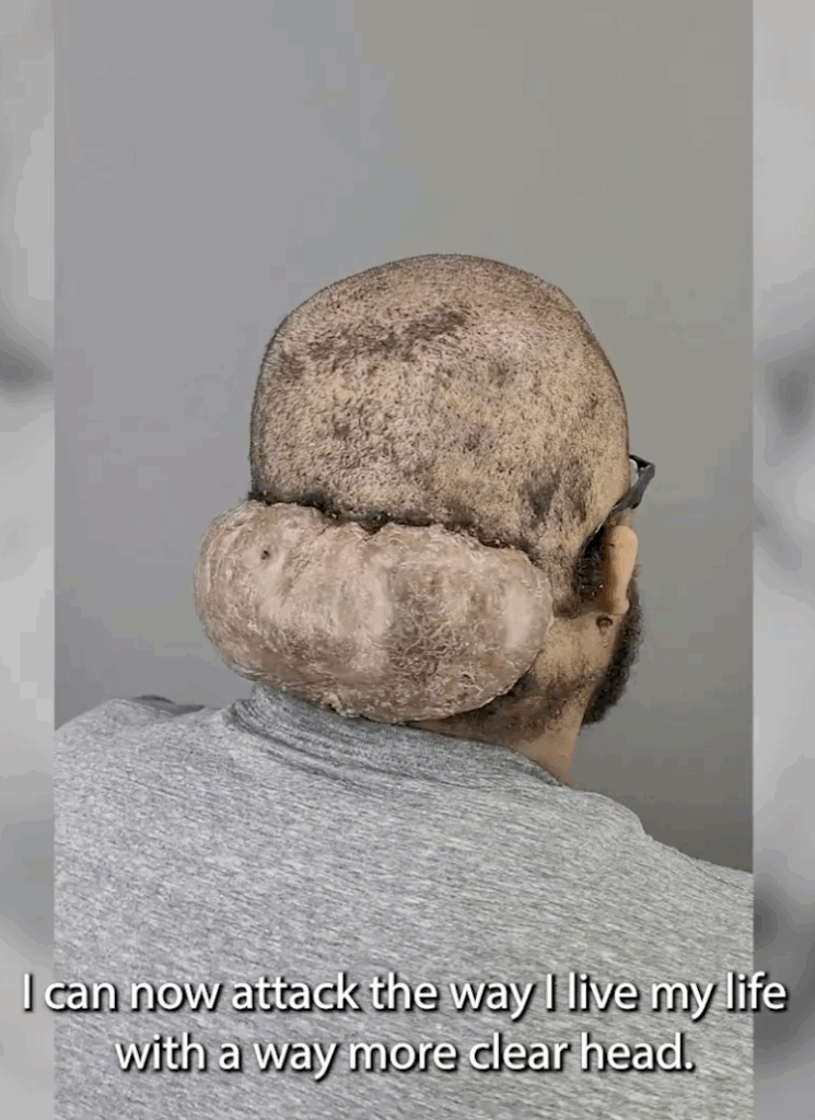 Side view of patient Adrian showing a large Acne Keloidalis Nuchae (AKN) mass on the back of his scalp before surgery at Dr. U Skin & Hair Clinic. The keloid-like growth illustrates the severe, untreated stage of AKN that caused years of pain, scarring, and emotional distress.